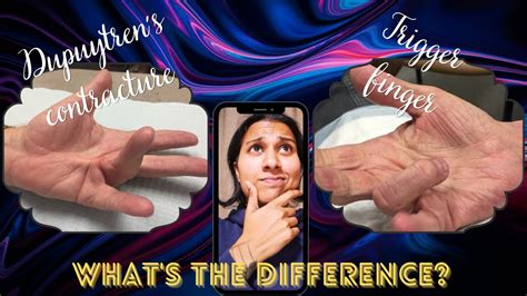 Dupuytrens Contracture Vs Trigger Finger Youtube