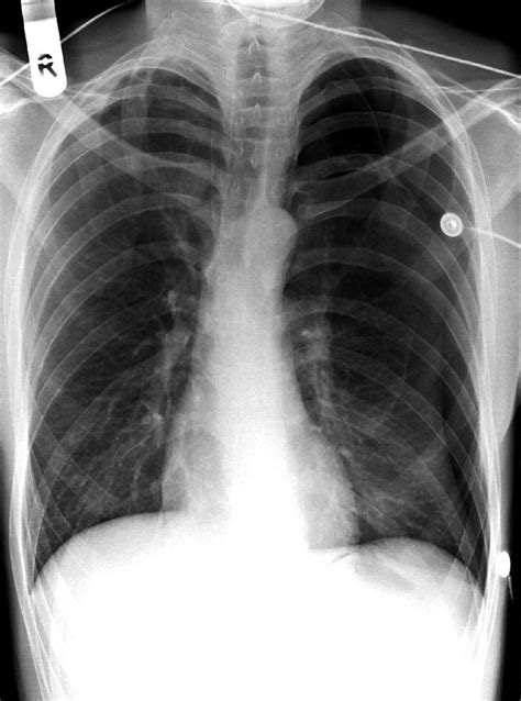 Pneumothorax X Ray 3 Photograph By Du Cane Medical Imaging Ltd Fine Art America