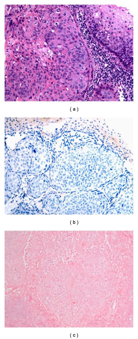 Moderately Differentiated Squamous Cell Carcinoma Hematoxylin And