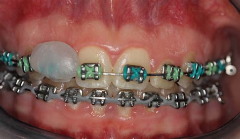 No matter how professional a specialist who installs braces, small problems can not be avoided. Due to my braces not working, I got screws in my gums, and ...