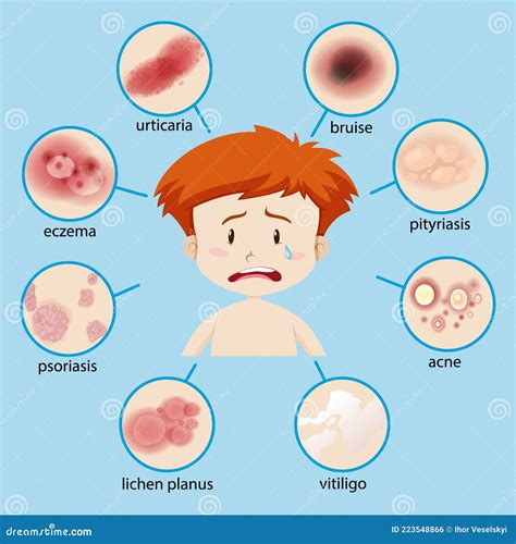 Diagram Showing Boy With Different Skin Conditions Stock Vector