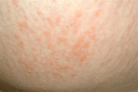 Pupps Rash Pictures Relief During Pregnancy About Skin Rash