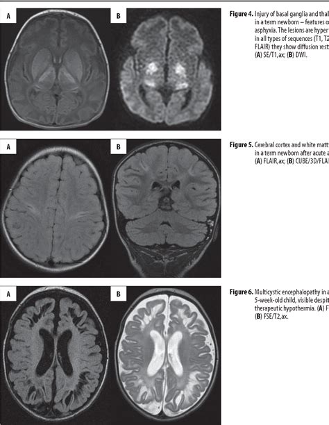 Mri Patterns Of Hypoxic Ischemic Brain Injury In Preterm And Full Term