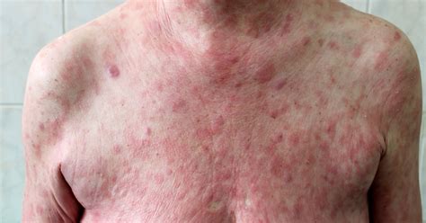 Best Drs And Hospitals In India For Cutaneous T Cell Lymphoma Treatment