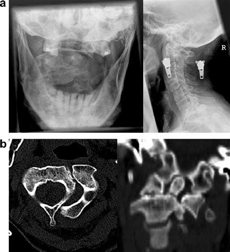 Lateral C1c2 Dislocation Complicating A Type Ii Odontoid Fracture