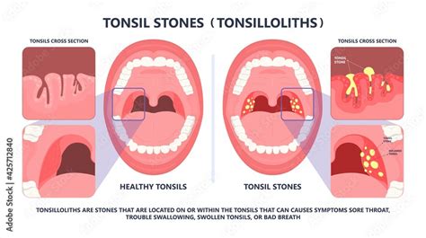 Fototapeta Tonsil Stones Crypts Viral Virus Gland Strep Throat Sore