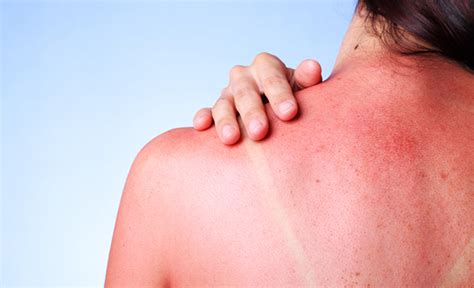 How To Relieve An Itchy Sunburn Fast According To Dermatologists