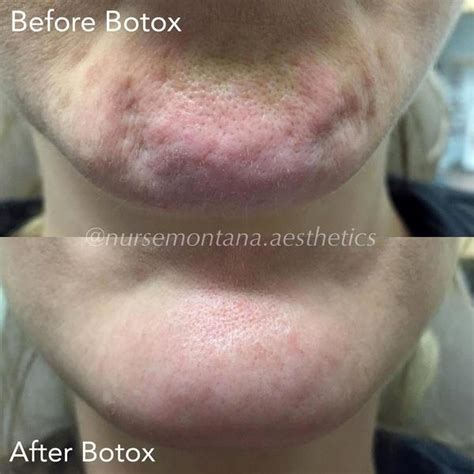 Botox Pebble Chin Facial Injections Info Prices Photos Reviews Qanda