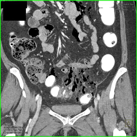 Diverticulitis With Abscess And Inflammation In Sigmoid Colon Colon