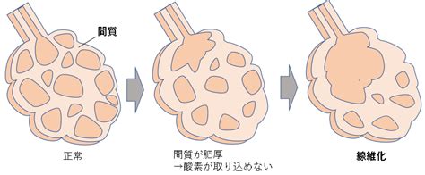 The latest tweets from ケイン・ヤリスギ「♂」 (@kein_yarisugi). 間質性肺炎は原因と検査をおさえる | マインドマップ薬学