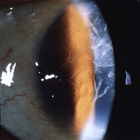 Corneal Dystrophies Presenting As Recurrent Erosions Ophthalmology Review