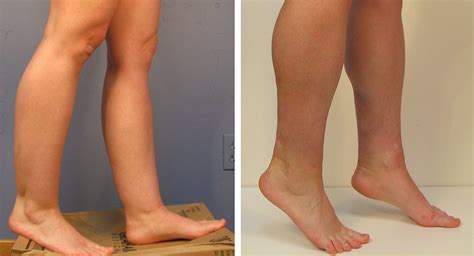 Ankle And Calf Reduction Liposuction St Louis Liposuction Center