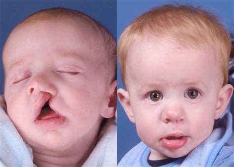 Cleft Lip Before And Afters James P Bradley Md
