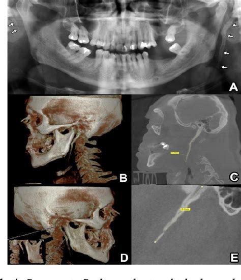 Figure 1 From Asymptomatic Bilateral Calcified Stylohyoid Ligaments
