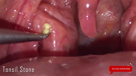 Tonsil Stone Removal And Monstrous Uvula Youtube
