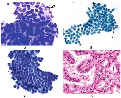 Cytomorphology Of Fine Needle Aspiration Of Thyroid Radiology Key