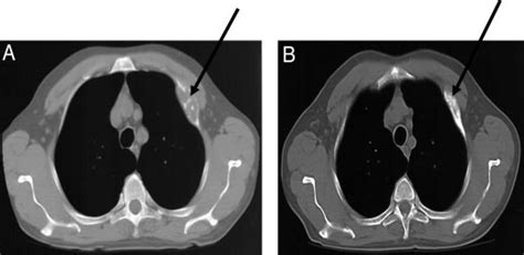 A Lytic Expansile Lesion Of The Anterior Arch Of The Second Rib With