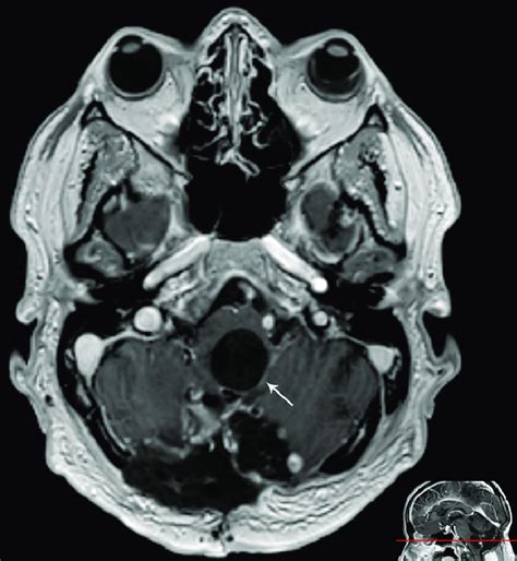 Presurgical Axial Gadolinium Contrast Enhanced T1 Weighted Mri The
