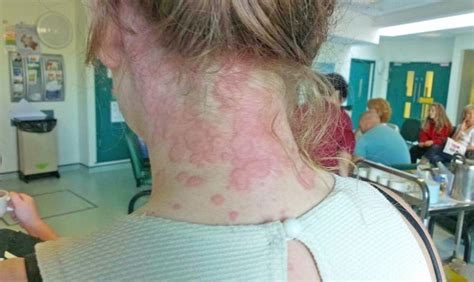 Woman Who Breaks Out In Red Hives Every Day Is Searching For A Cure