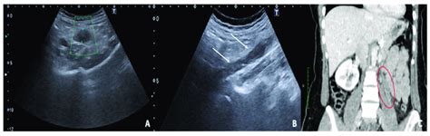 Thrombosis Of The Right Gonadal Vein Tsa Us Scan Of The Left Ovarian