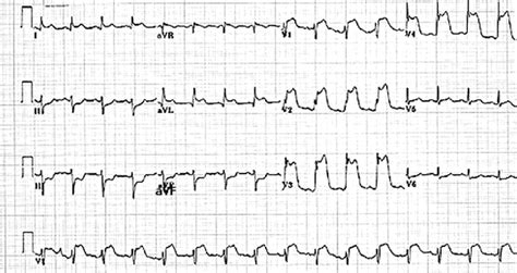 E Ecg Showing Anterior Wall Mi St Elevation In Leads V1 4 With