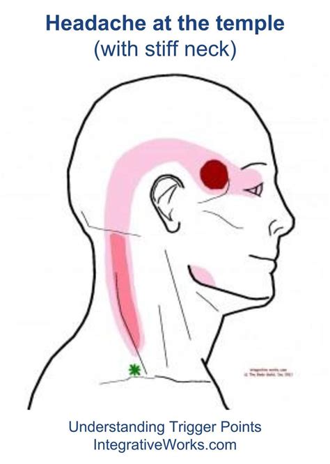 Stiff Neck Integrative Works Trigger Points Migraine Headaches