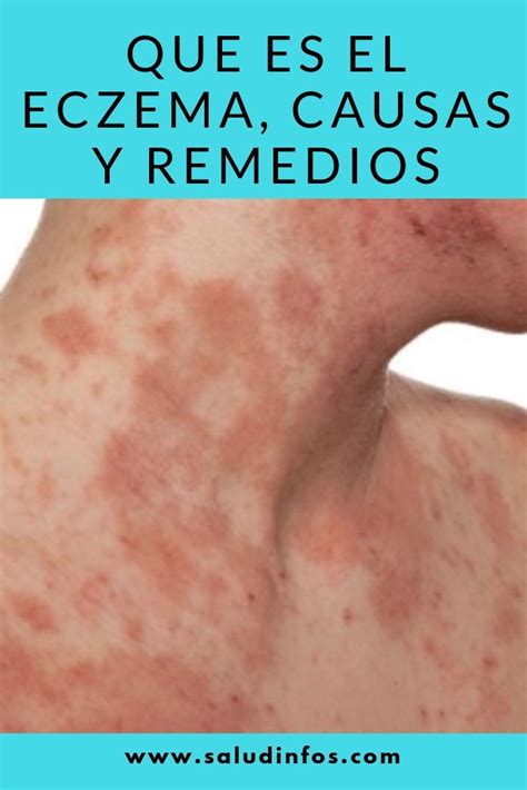 Que Es El Eczema Causas Sintomas Y Remedios Caseros Y Naturales Eczema