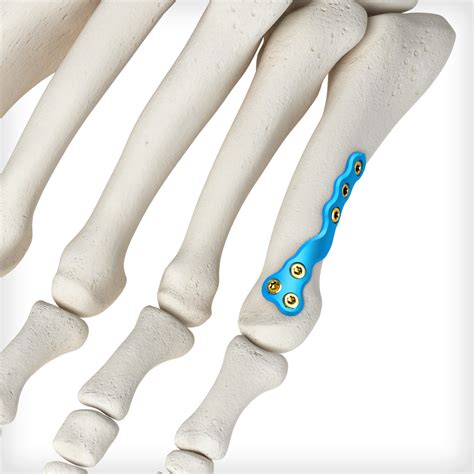 Th Metatarsal Spiral Fracture Plates Unite Foot And Ankle