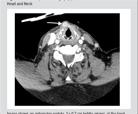 Figure 1 From Ectopic Thyroid Tissue With Hashimotos Thyroiditis