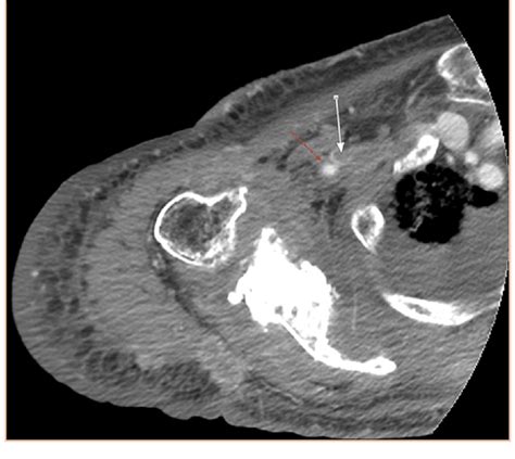 Axial Contrast Enhanced Ct Of The Right Upper Extremity Showing