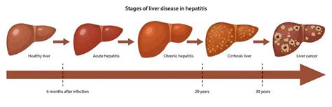 Liver Disease Progression Chart