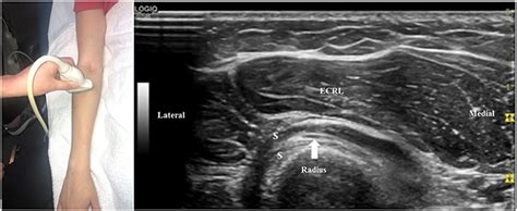 Frontiers Ultrasound In The Evaluation Of Radial Neuropathies At The