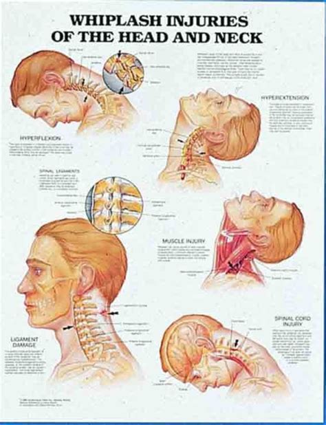 Whiplash Injuries To The Head And Neck Chart Medwest Medical Supplies