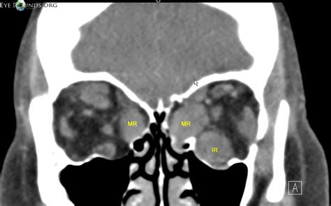 Enlarged Muscle Bellies In Thyroid Eye Disease