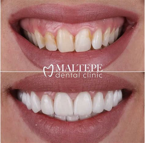 The Teeth Reshaping Procedure What To Expect Maltepe Dental Clinic