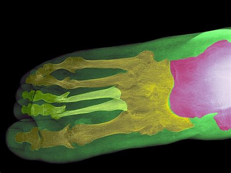 Psoriatic Arthritis Foot Pain Linked To Inflammation