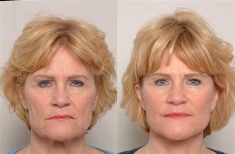 Maybe you would like to learn more about one of these? Hyperpigmentation Correction - Dr. James Romano