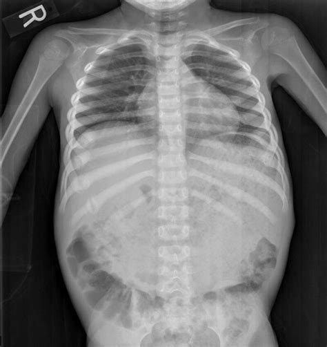 Chest X Ray Multiple Bilateral Rib Fractures In Various Stages Of
