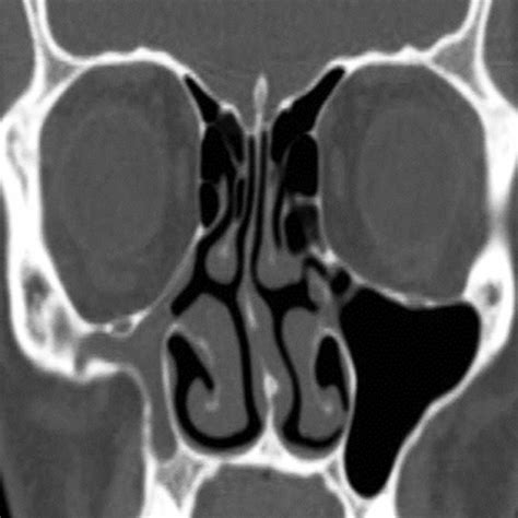 CT Scan Of Paranasal Sinus Axial View Showing Normal Ethmoid Sinus Download Scientific Diagram