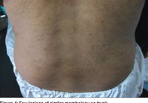 Figure 4 From Hyperkeratosis Lenticularis Perstans Case Report Of A