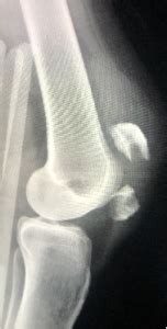 Patella Fracture Broken Kneecap Reno Orthopedic Center