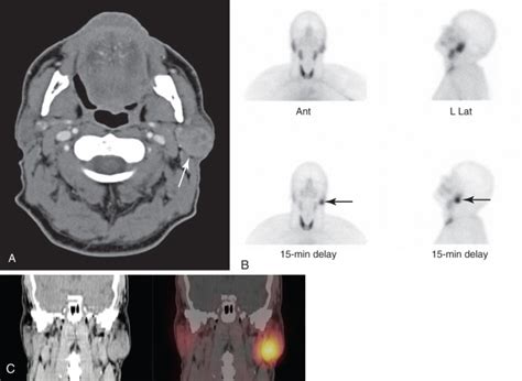 Thyroid Parathyroid And Salivary Glands Radiology Key