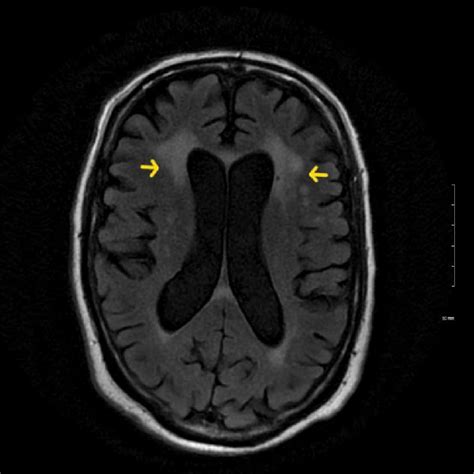 Mri Of The Brain Showing Bilateral Periventricular White Matter Lesions