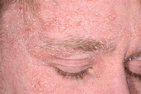 Seborrheic Dermatitis Pictures