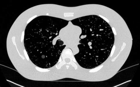 Example Of A Lung Phantom Ct Scan Acquired With Slice Thickness