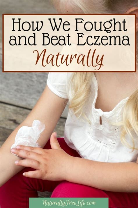 How We Managed Eczema Naturally Serious Skin Care How To Treat