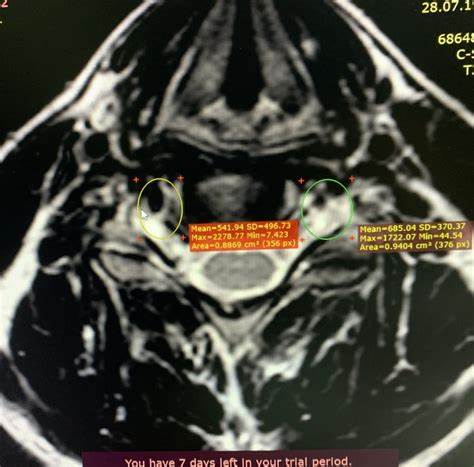 Остеофиты лечение диета Остеохондроз, деформирующий спонделез (остеофиты) - лечение, симптомы Остеохондроз, деформирующий спонделез (остеофиты) - лечение, симптомы Остеофиты лечение диета