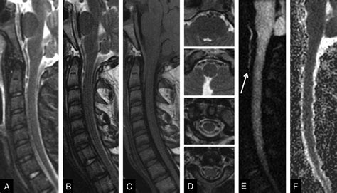 Clinical Evaluation Of Reduced Field Of View Diffusion Weighted Imaging