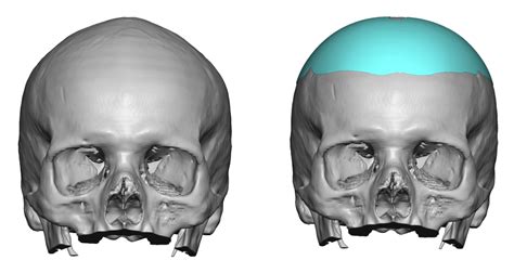 Plastic Surgery Case Study Correction Of The Inverted V Head Shape