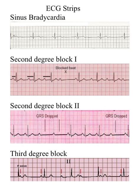How Do You Read Cardiac Rhythm Strips Robert Reeses Reading Worksheets